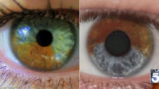 Карие глаза можно сделать голубыми