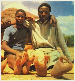 25% жителей Зимбабве рождаются всего с двумя пальцами на ногах