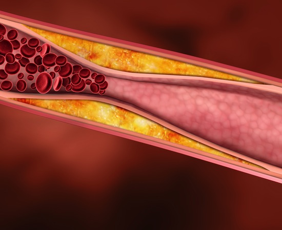 На самом деле холестерин почти не влияет на болезни сердца и сосудов
