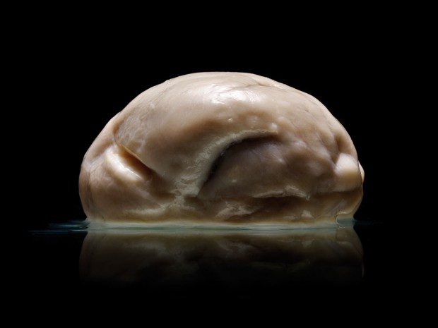 Самый необычный человеческий мозг из известных науке
