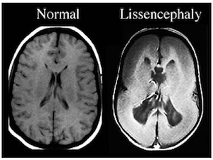Лиссэнцефалия
