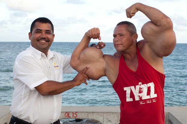 Обладатель самых больших бицепсов в Бразилии накачал мышцы жиром и спиртом