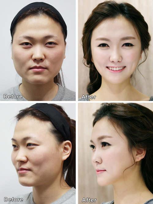В Южной Корее пластические хирурги меняют лица пациентов до полной неузнаваемости
