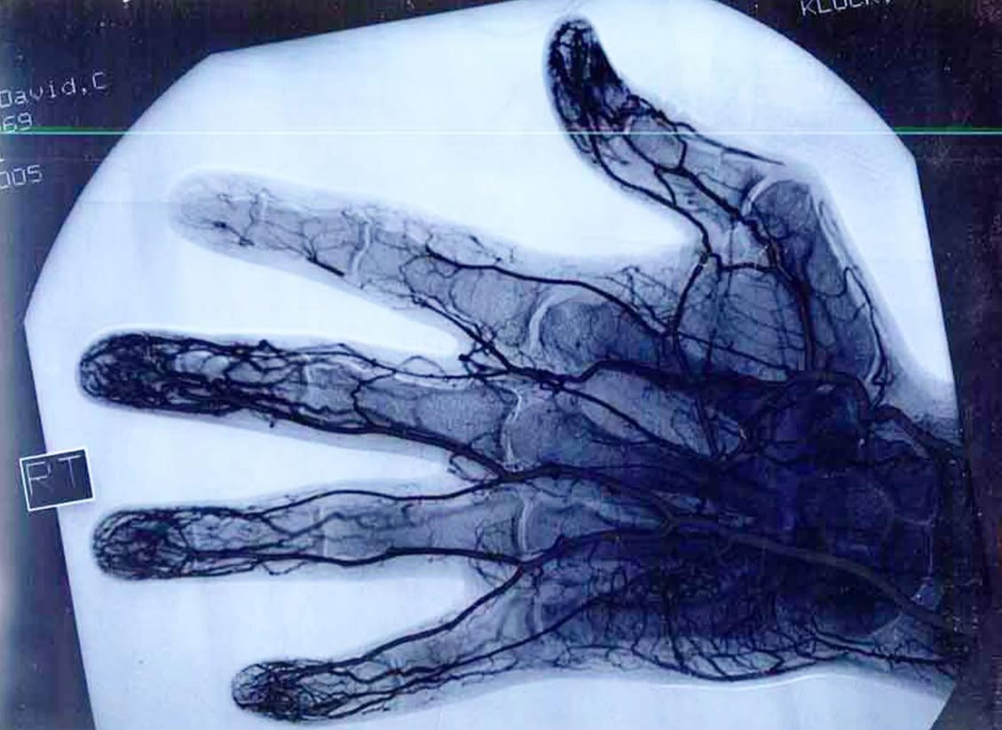 Рентгеновский снимок кровеносной системы кисти руки.