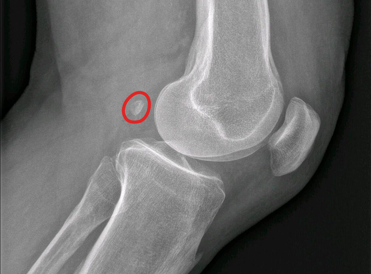 Дополнительная кость «фабелла» на рентгеновском снимке коленного сустава 