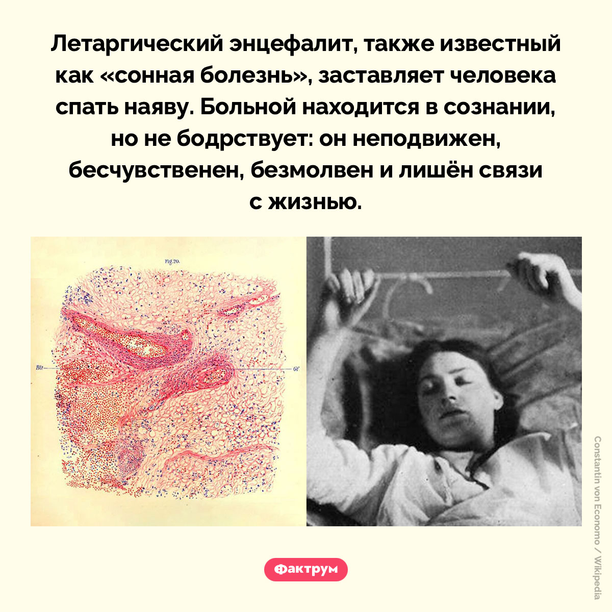 Что такое летаргический энцефалит. Летаргический энцефалит, также известный как «сонная болезнь», заставляет человека спать наяву. Больной находится в сознании, но не бодрствует: он неподвижен, бесчувственен, безмолвен и лишён связи с жизнью.