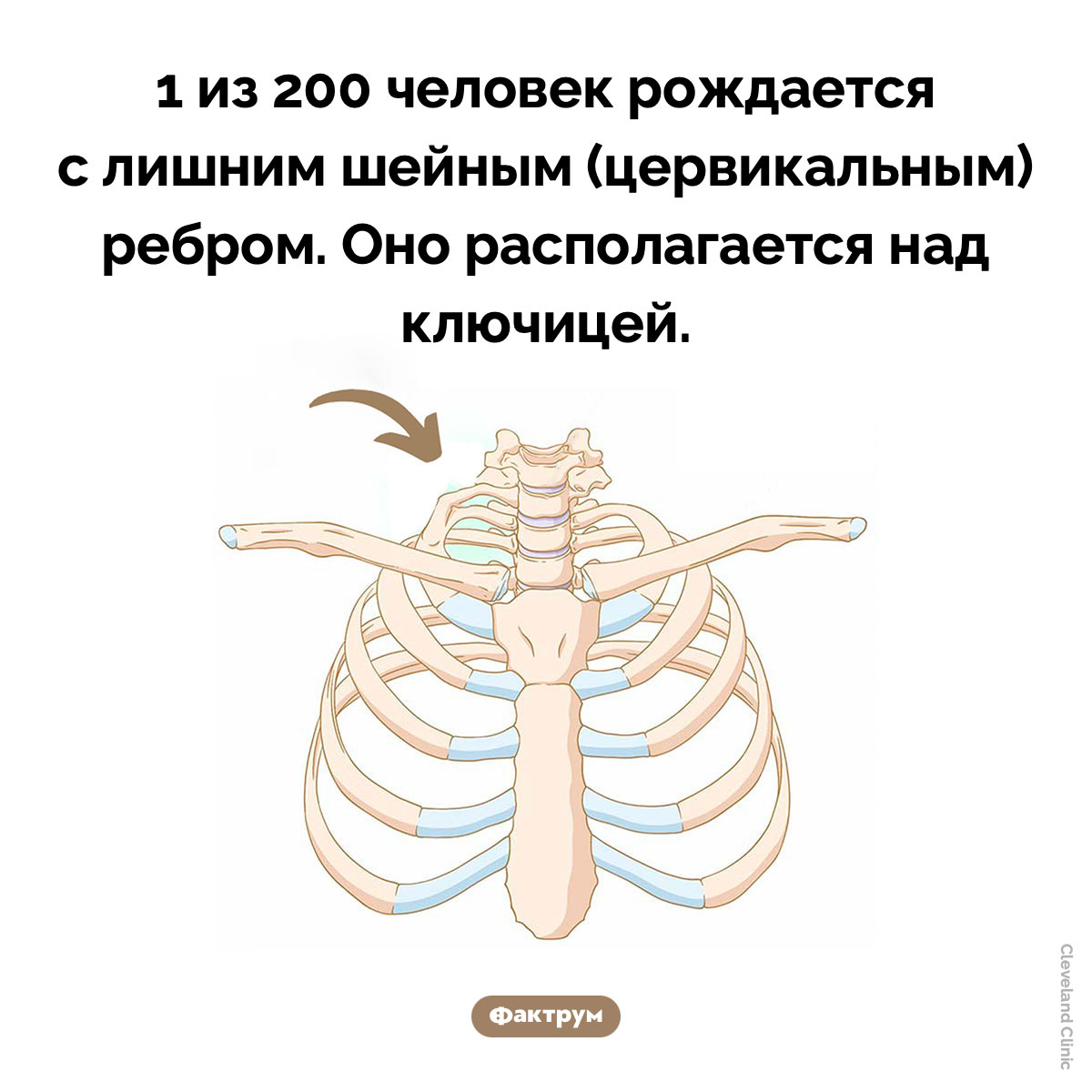 Лишнее ребро. 1 из 200 человек рождается с лишним шейным (цервикальным) ребром. Оно располагается над ключицей.