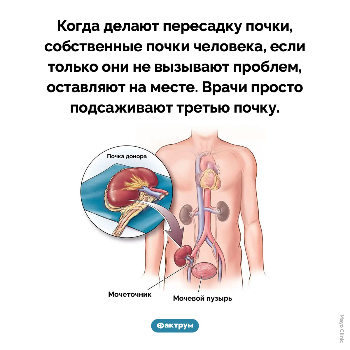 Пересадка почки. Когда делают пересадку почки, собственные почки человека, если только они не вызывают проблем, оставляют на месте. Врачи просто подсаживают третью почку.