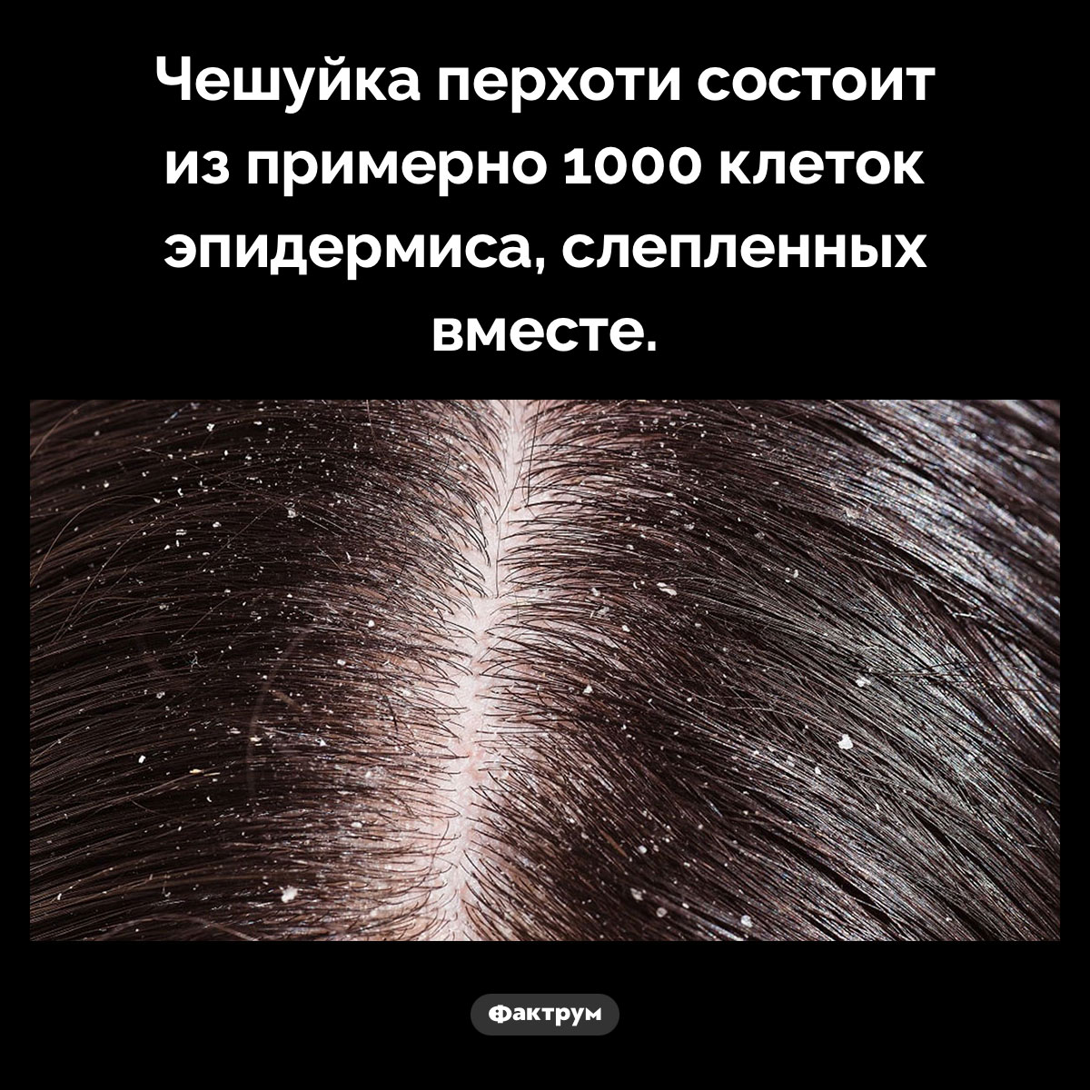 Что такое перхоть. Чешуйка перхоти состоит из примерно 1000 клеток эпидермиса, слепленных вместе.