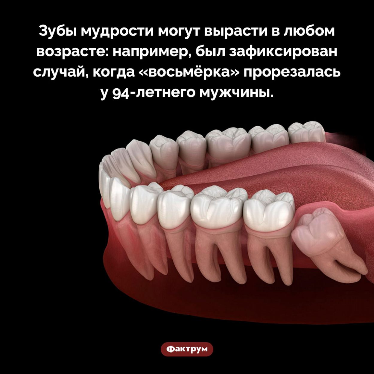Во сколько лет растут зубы мудрости. Зубы мудрости могут вырасти в любом возрасте: например, был зафиксирован случай, когда «восьмёрка» прорезалась у 94-летнего мужчины.