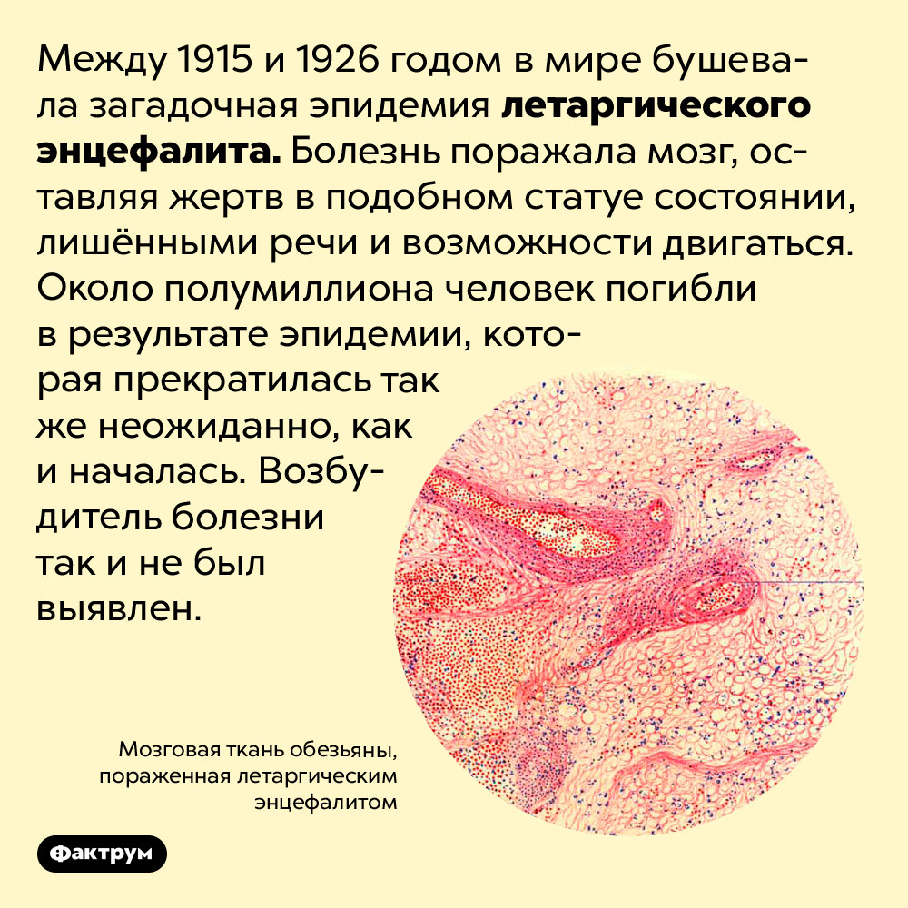 Загадочный летаргический энцефалит превращал людей в статуи. Между 1915 и 1926 годом в мире бушевала загадочная эпидемия летаргического энцефалита. Болезнь поражала мозг, оставляя жертв в подобном статуе состоянии, лишёнными речи и возможности двигаться. Около полумиллиона человек погибли в результате эпидемии, которая прекратилась так же неожиданно, как и началась. Возбудитель болезни так и не был выявлен.