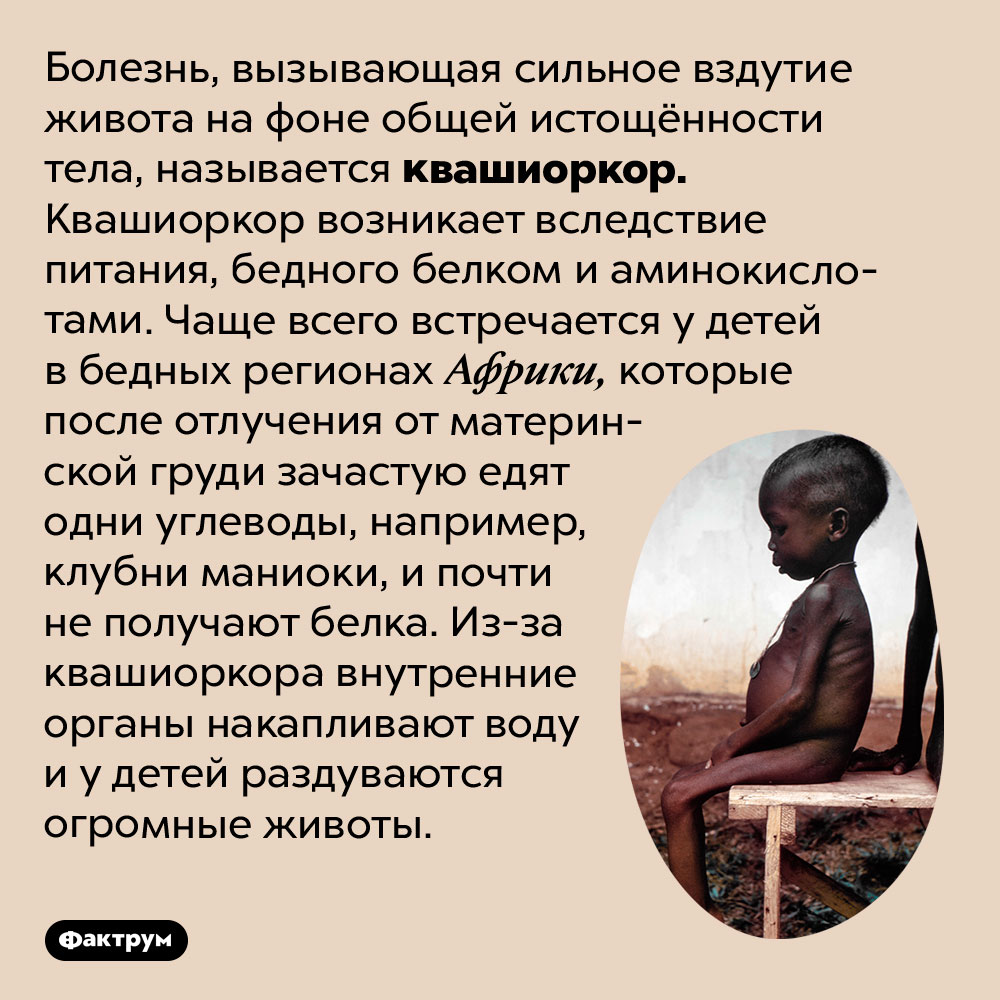 Почему у истощённых африканских детей большие животы. Болезнь, вызывающая сильное вздутие живота на фоне общей истощённости тела, называется квашиоркор. Квашиоркор возникает вследствие питания, бедного белком и аминокислотами. Чаще всего встречается у детей в бедных регионах Африки, которые после отлучения от материнской груди зачастую едят одни углеводы, например, клубни маниоки, и почти не получают белка. Из-за квашиоркора внутренние органы накапливают воду и у детей раздуваются огромные животы.