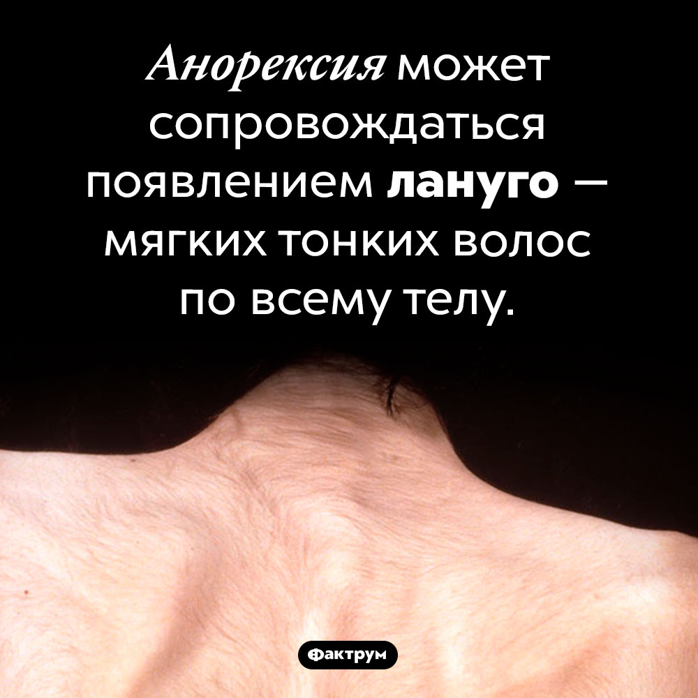 Странный симптом анорексии. Анорексия может сопровождаться появлением лануго — мягких тонких волос по всему телу.