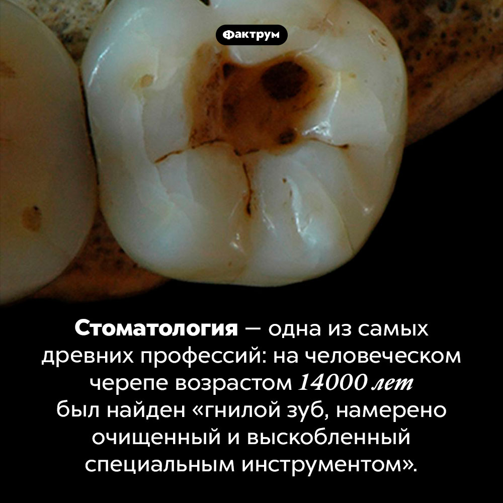 Стоматология — одна из старейших профессий. Стоматология — одна из самых древних профессий: на человеческом черепе возрастом 9000 лет был найден «гнилой зуб, намерено очищенный и выскобленный специальным инструментом».
