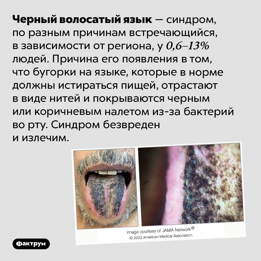 Синдром черного волосатого языка. Черный волосатый язык — синдром, по разным причинам встречающийся, в зависимости от региона, у 0,6–13% людей. Причина его появления в том, что бугорки на языке, которые в норме должны истираться пищей, отрастают в виде нитей и покрываются черным или коричневым налетом из-за бактерий во рту. Синдром безвреден и излечим.