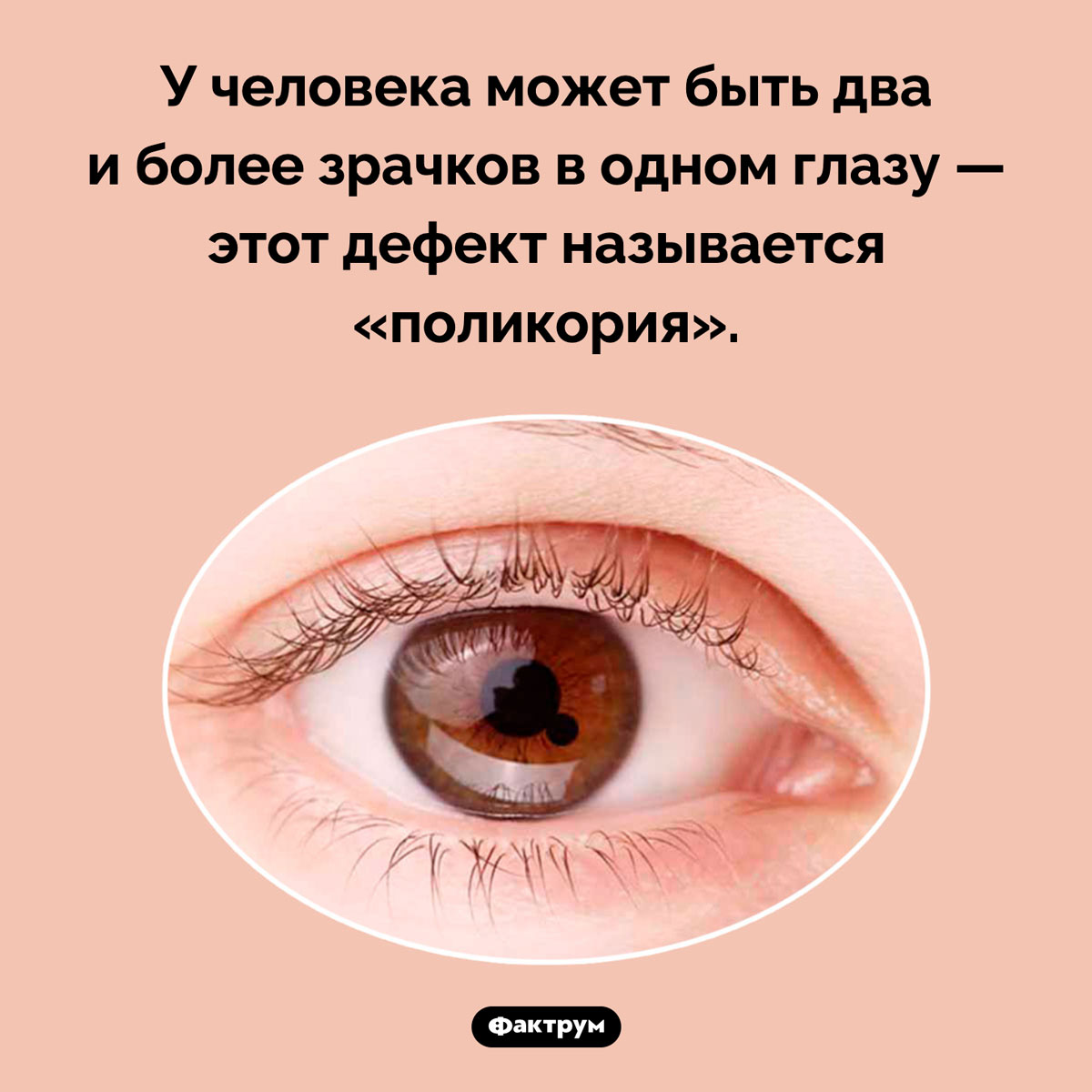 Может ли в глазу быть два зрачка. У человека может быть два и более зрачков в одном глазу — этот дефект называется «поликория».