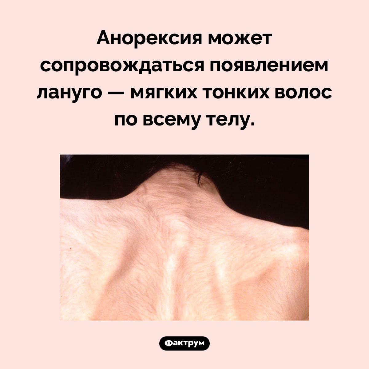 Странный симптом анорексии. Анорексия может сопровождаться появлением лануго — мягких тонких волос по всему телу.