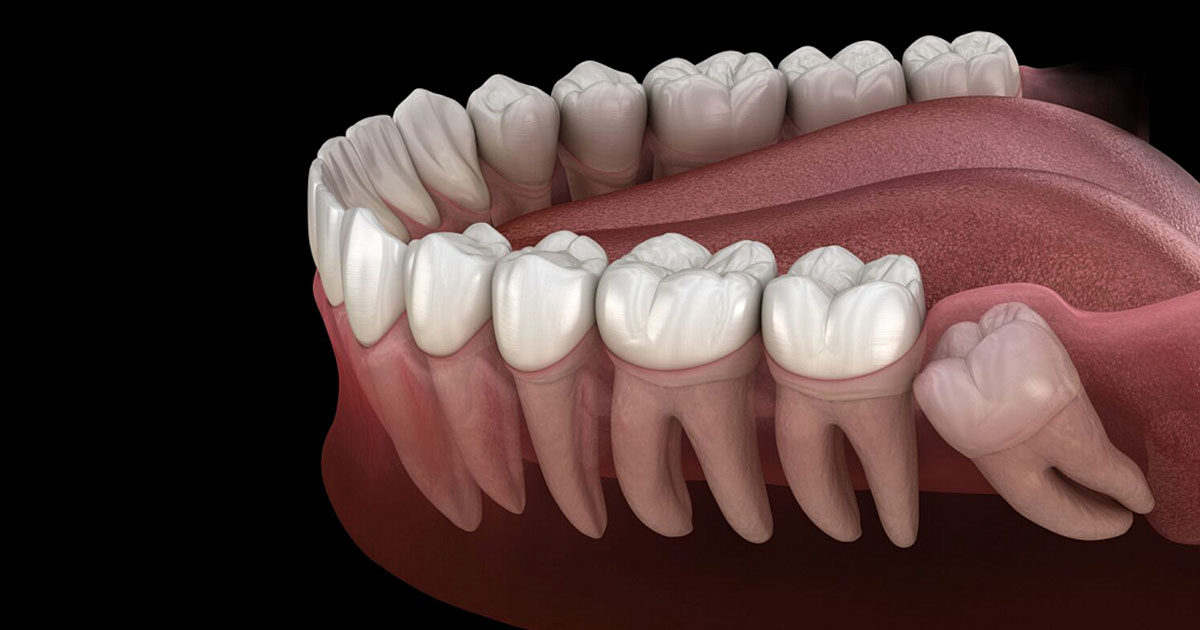 Во сколько лет растут зубы мудрости