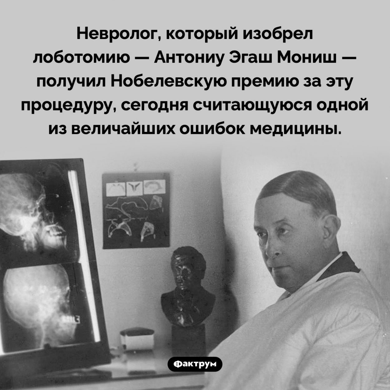 Нобелевка за лоботомию. Невролог, который изобрел лоботомию — Антониу Эгаш Мониш — получил Нобелевскую премию за эту процедуру, сегодня считающуюся одной из величайших ошибок медицины.