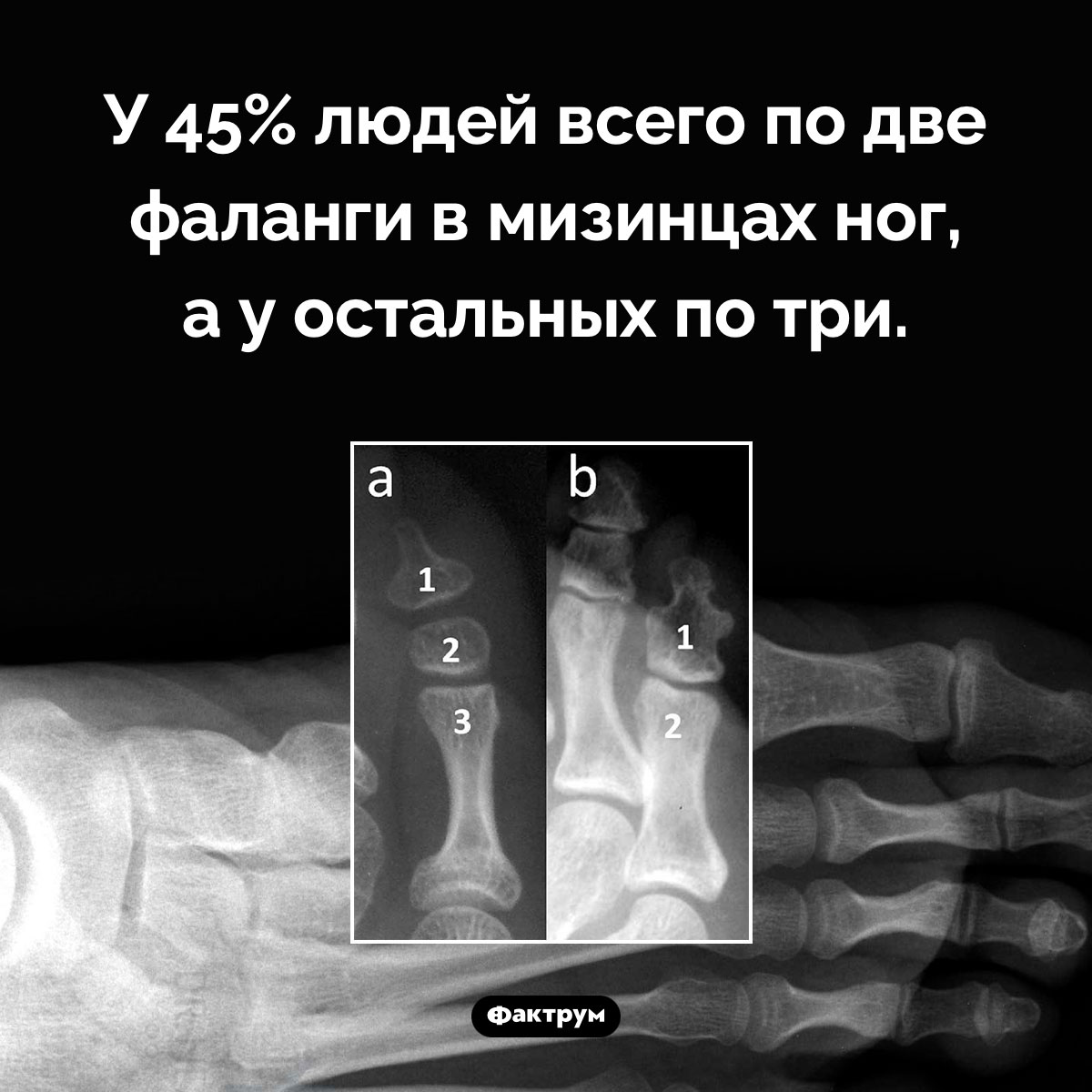 Сколько фаланг в мизинцах ног. У 45% людей всего по две фаланги в мизинцах ног, а у остальных по три.