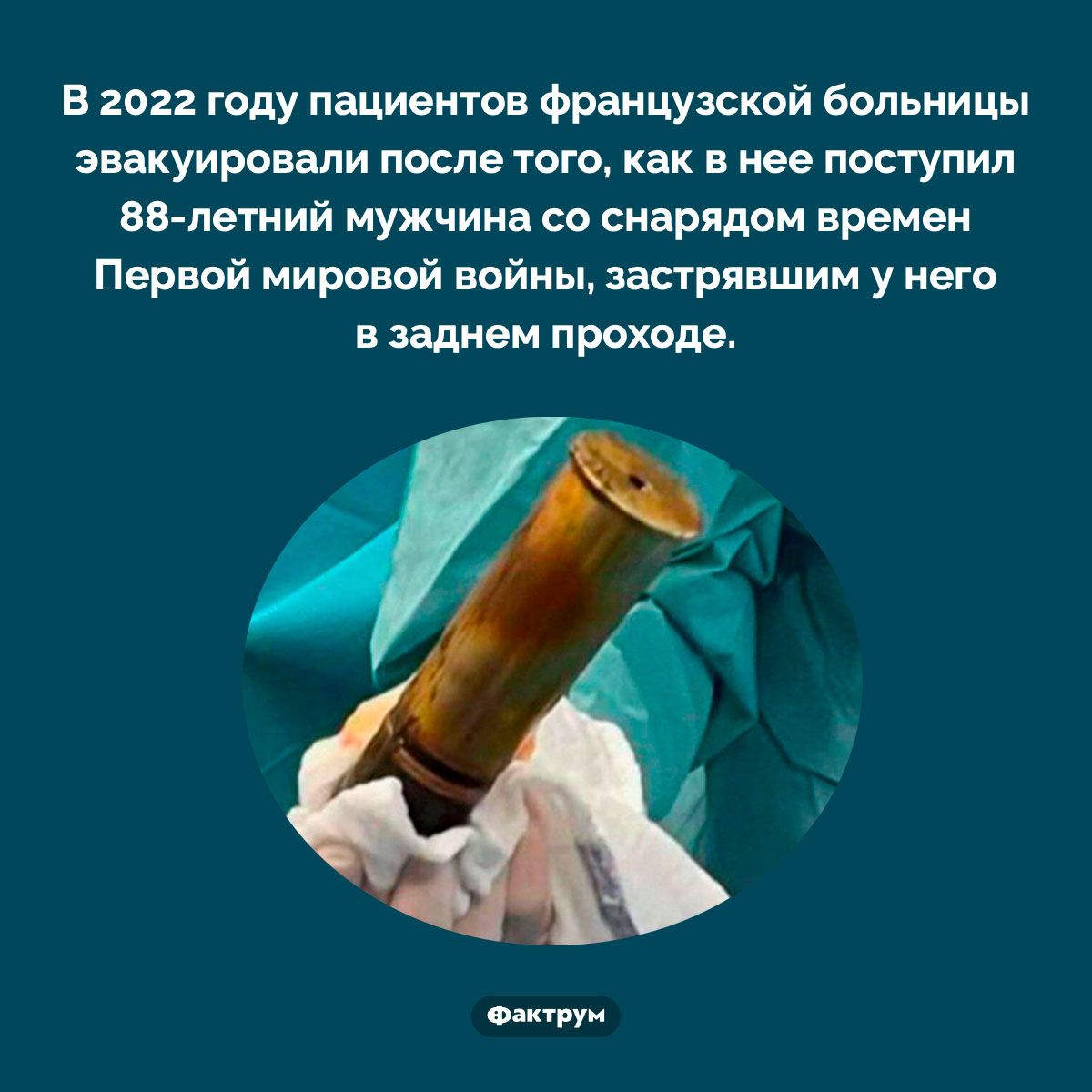 88-летний мужчина со снарядом в заднем проходе. В 2022 году пациентов французской больницы эвакуировали после того, как в нее поступил 88-летний мужчина со снарядом времен Первой мировой войны, застрявшим у него в заднем проходе.