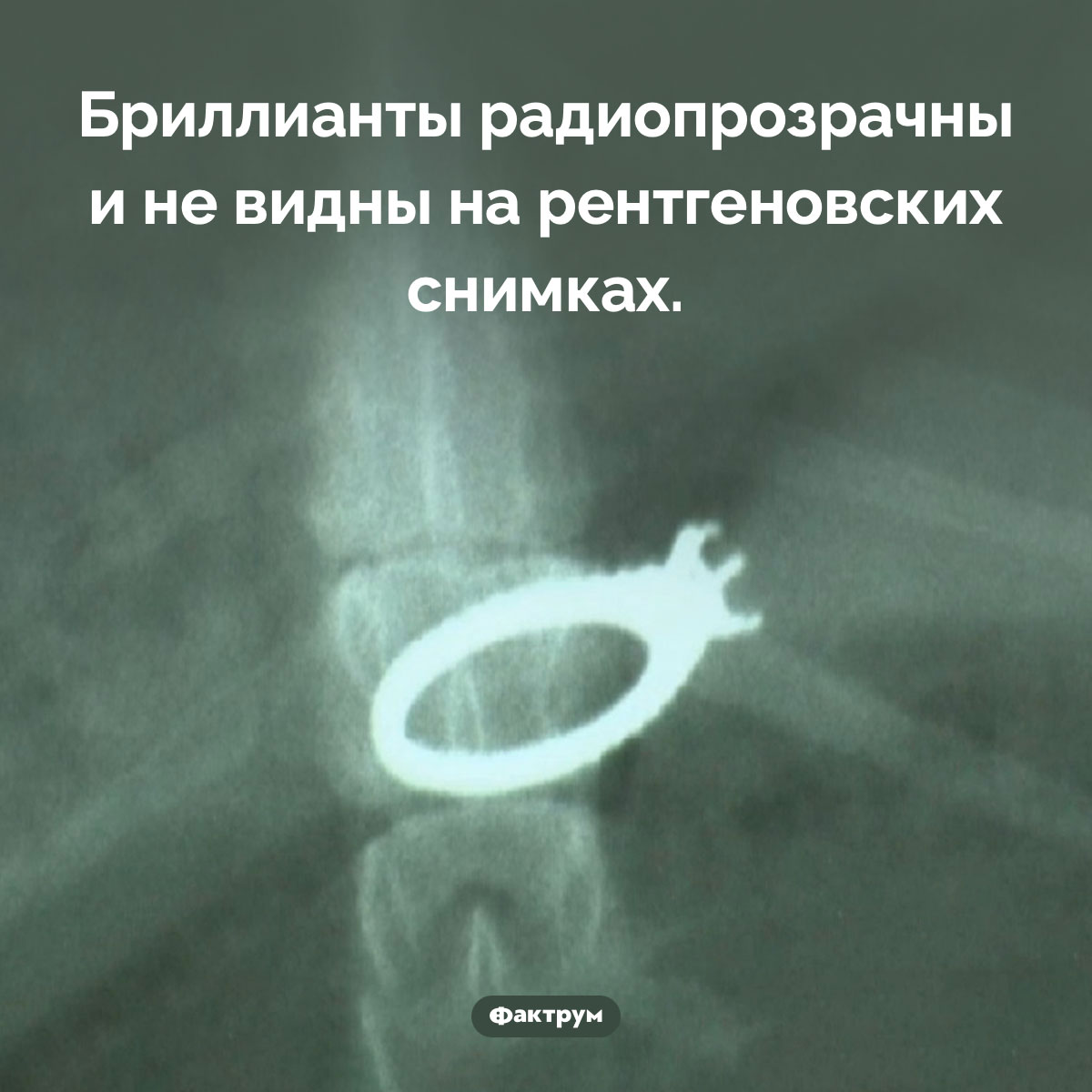 Радиопрозрачность бриллиантов. Бриллианты радиопрозрачны и не видны на рентгеновских снимках.