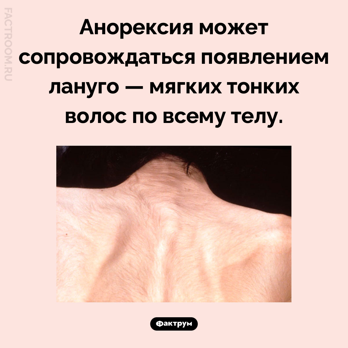 Странный симптом анорексии. Анорексия может сопровождаться появлением лануго — мягких тонких волос по всему телу.