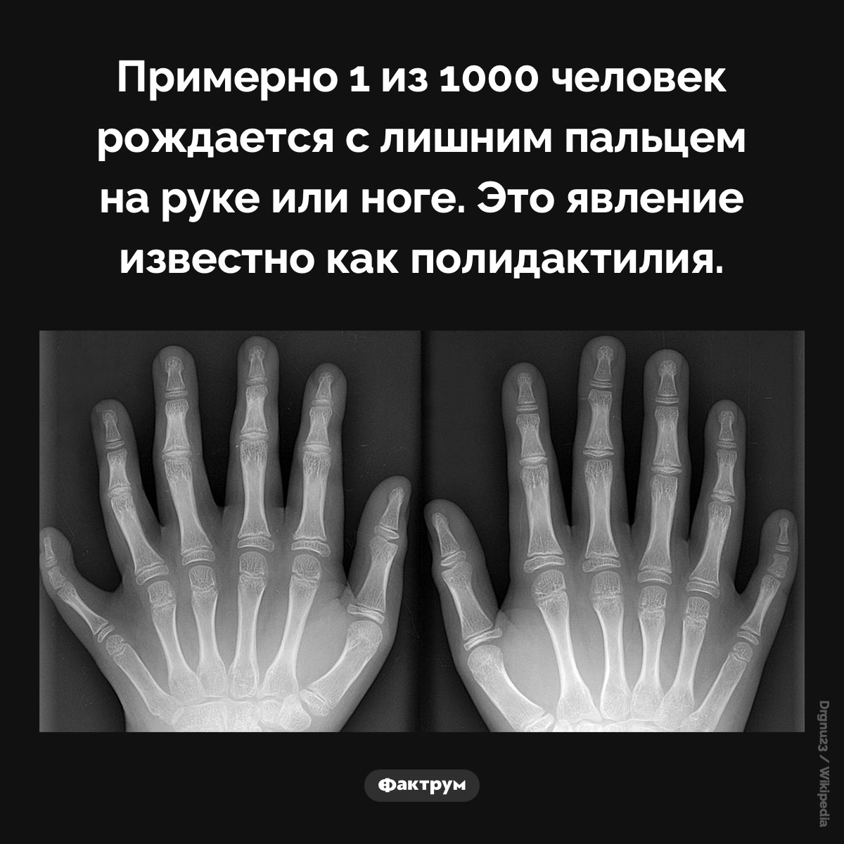 Полидактилия. Примерно 1 из 1000 человек рождается с лишним пальцем на руке или ноге. Это явление известно как полидактилия.