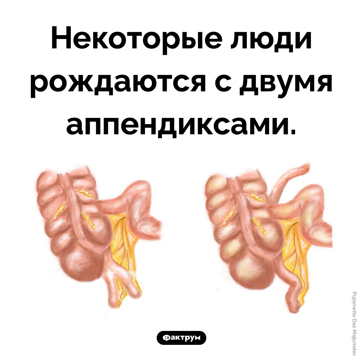 Два аппендикса. Некоторые люди рождаются с двумя аппендиксами.