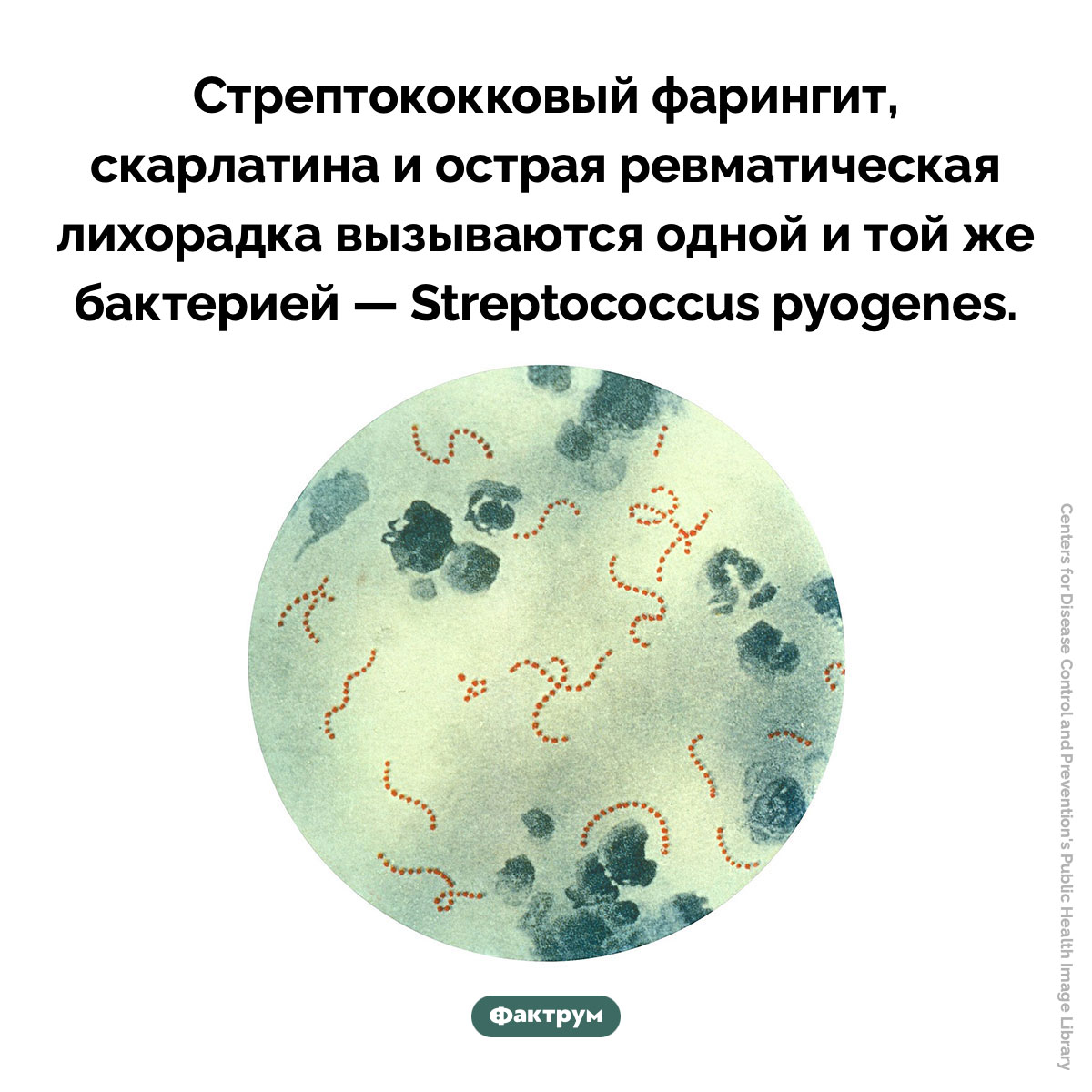 Streptococcus pyogenes. Стрептококковый фарингит, скарлатина и острая ревматическая лихорадка вызываются одной и той же бактерией — Streptococcus pyogenes.