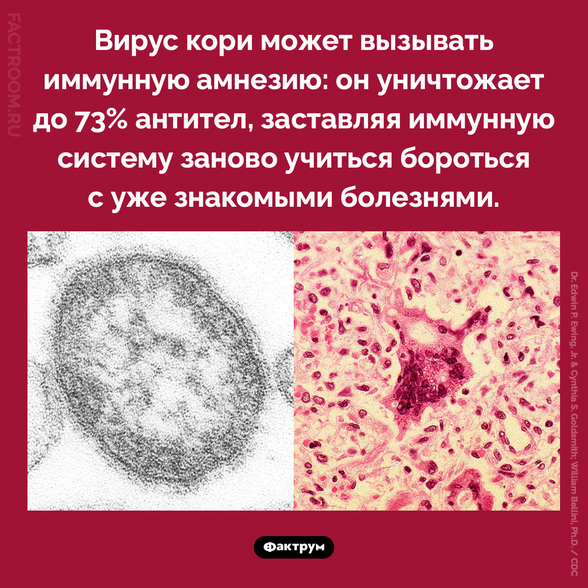 Именная амнезия от кори. Вирус кори может вызывать иммунную амнезию: он уничтожает до 73% антител, заставляя иммунную систему заново учиться бороться с уже знакомыми болезнями.