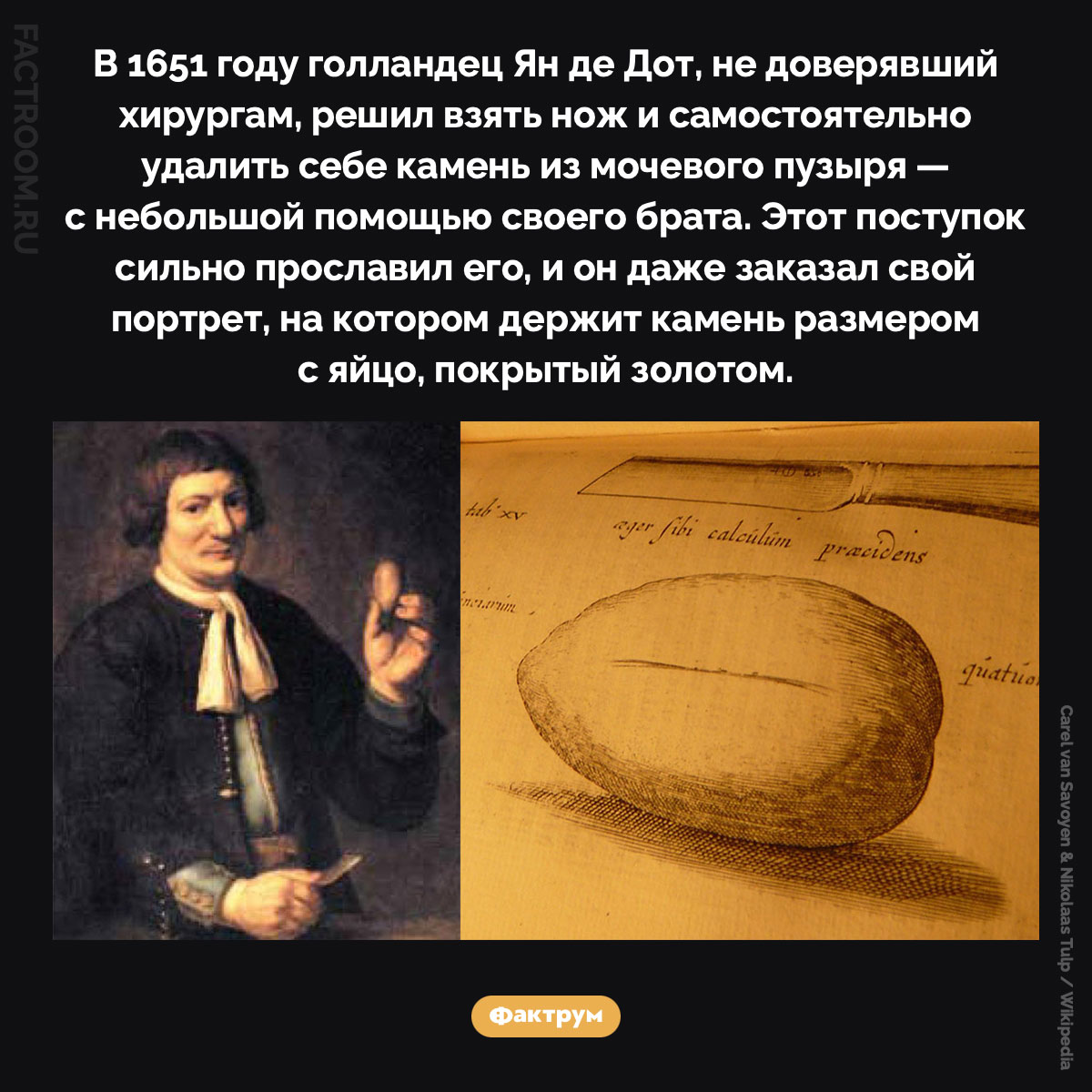 Ян де Дот, не доверявший хирургам. В 1651 году голландец Ян де Дот, не доверявший хирургам, решил взять нож и самостоятельно удалить себе камень из мочевого пузыря — с небольшой помощью своего брата. Этот поступок сильно прославил его, и он даже заказал свой портрет, на котором держит камень размером с яйцо, покрытый золотом.