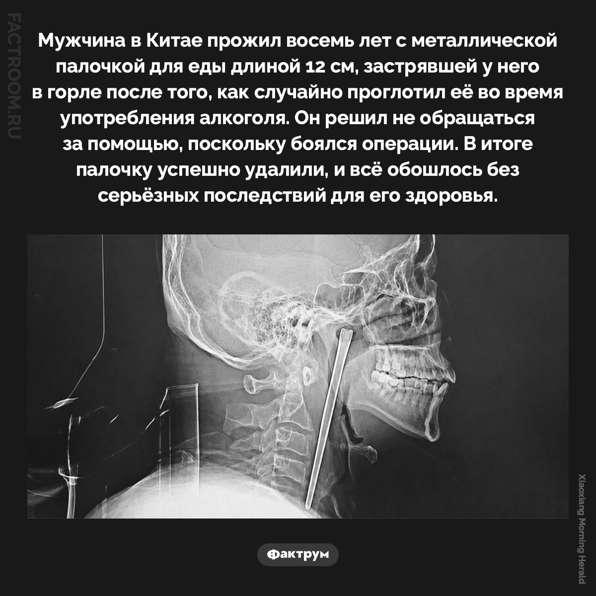 Палочка в горле. Мужчина в Китае прожил восемь лет с металлической палочкой для еды длиной 12 см, застрявшей у него в горле после того, как случайно проглотил её во время употребления алкоголя. Он решил не обращаться за помощью, поскольку боялся операции. В итоге палочку успешно удалили, и всё обошлось без серьёзных последствий для его здоровья.