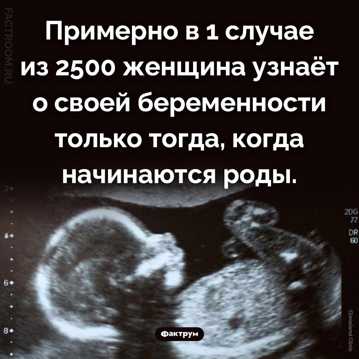 Скрытая беременность. Примерно в 1 случае из 2500 женщина узнаёт о своей беременности только тогда, когда начинаются роды.